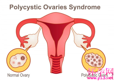 喝水都胖、月经不调的罪魁祸首竟然是多囊卵巢综合征！